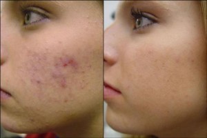 1269414917_73704856_1-pictures-of-women-beauty-acne-problem-ended-with-fair-face