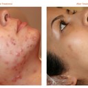 Best-acne-spot-treatment