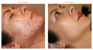 Best-acne-spot-treatment