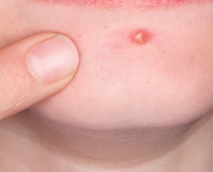 acne-spot-treatment-800x800