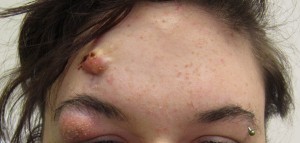 cystic-acne-treatment-2